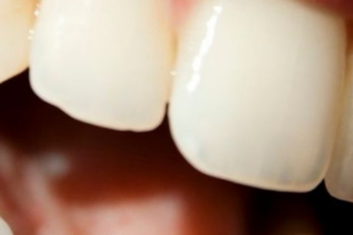  Cirurgião dentista explica se o uso de piercing no dente pode afetar a saúde bucal
