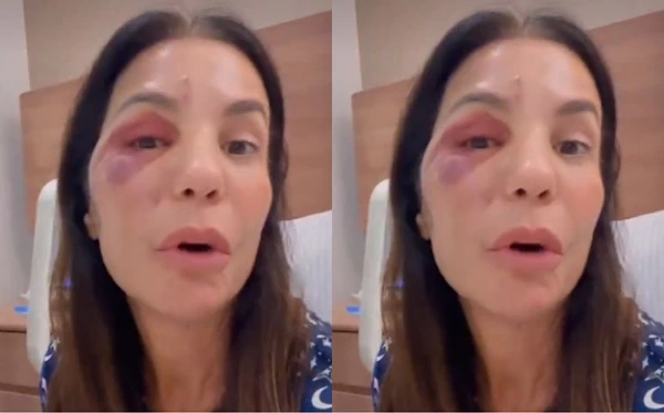  Como Ivete Sangalo está após cirurgia? Cantora detalha fratura no rosto e tranquiliza fãs